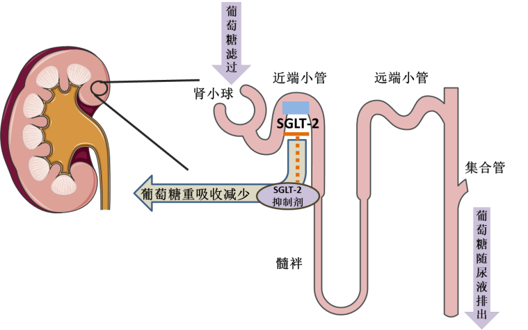 糖尿病患者新型降糖药物有哪些?