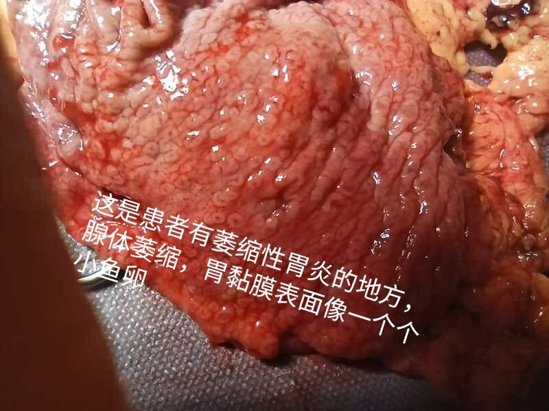 6年胃炎,却成胃癌,原因为何