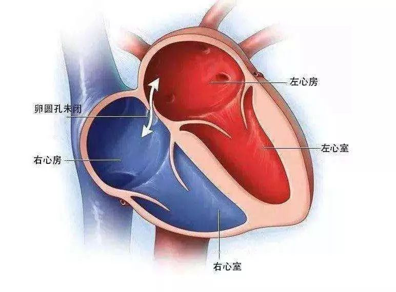 脑袋昏昏沉沉,却是心脏的"小孔"在作怪_卵圆孔未闭