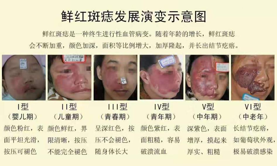 成人鲜红斑痣接受海姆泊芬光动力治疗效果如何?