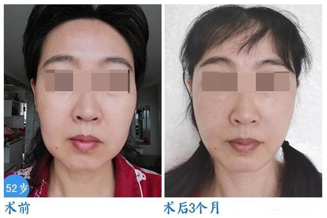 面部皮肤松弛下垂,法令纹重,哪种面部提升方式比较合适?