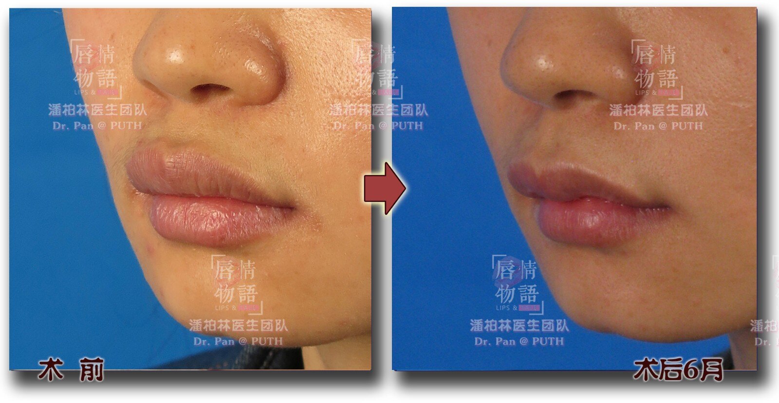 上唇综合整形(upper lip vermilion plasty):修薄/m唇