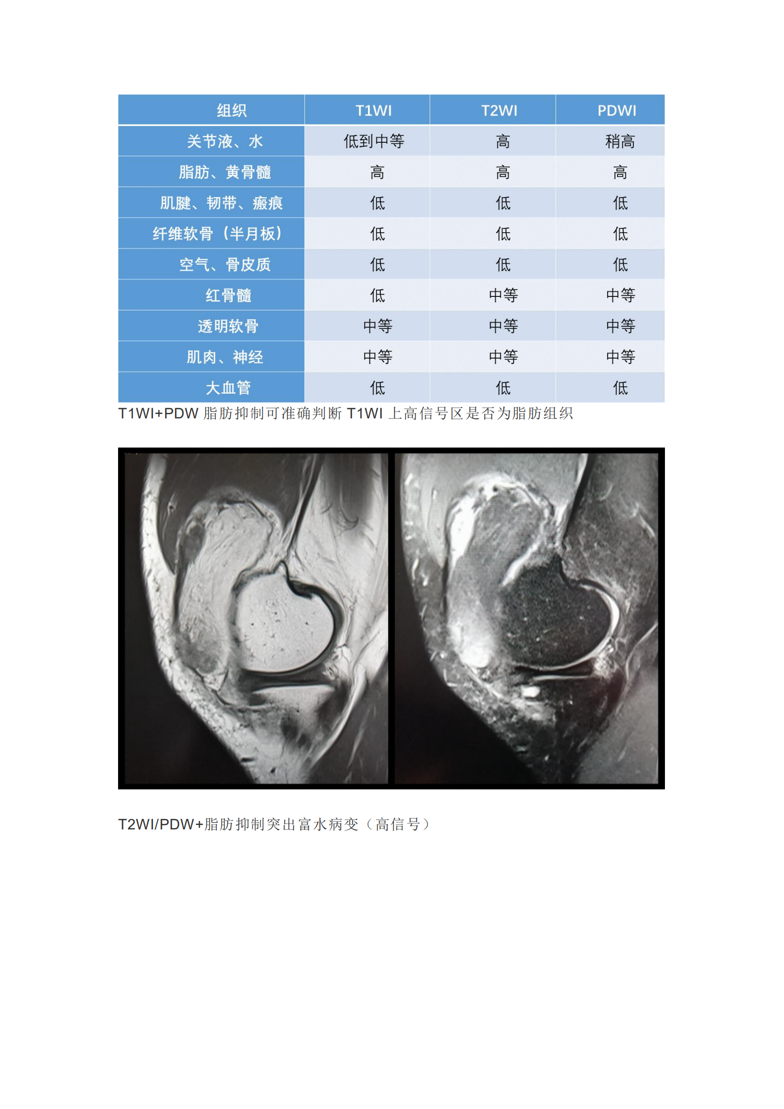 膝关节半月板病变的核磁共振检查的诊断与鉴别