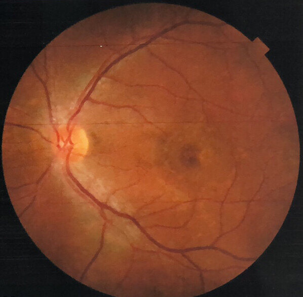 黄斑疾病之中心性浆液性脉络膜视网膜病变_中浆 - 好