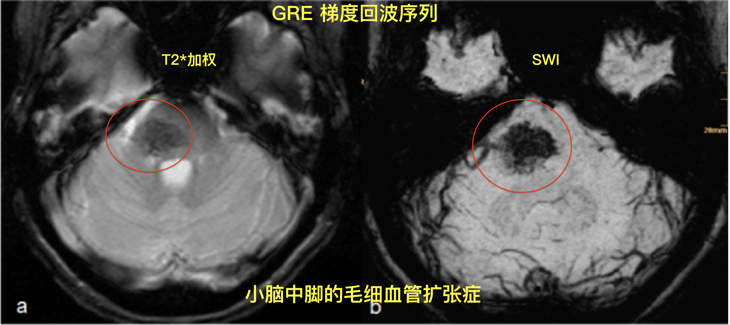 毛细血管扩张症