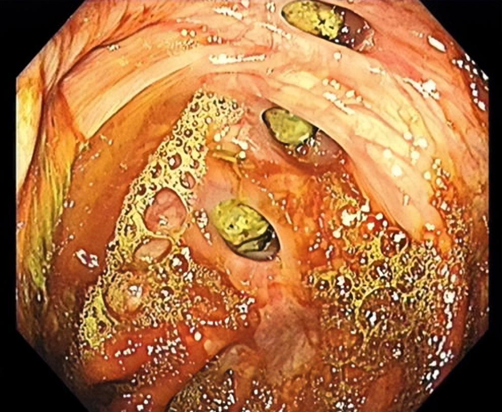 结肠憩室病(colon diverticular disease)