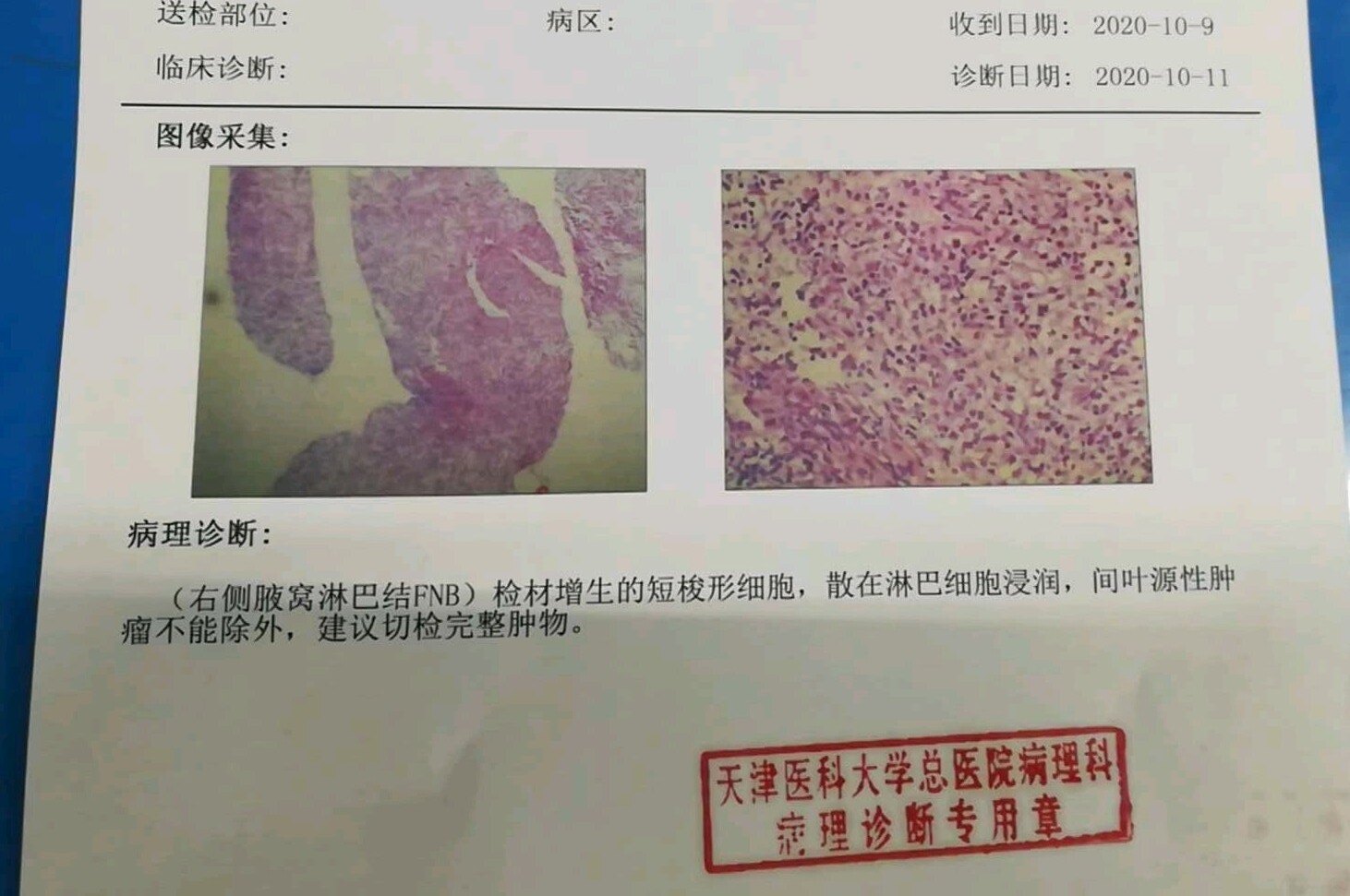 让我看看是不是和肺相关,我把她的病理报告发在了下面,根据这份病理
