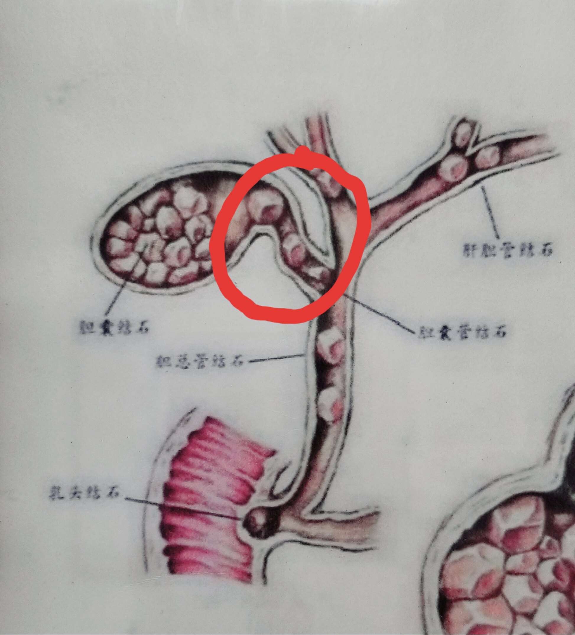 造成这种情况,最常见的原因是胆囊颈部或胆囊管结石嵌顿(画红圈处)