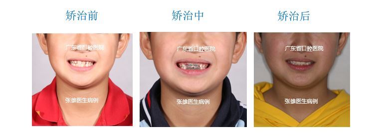 个别前牙反牙合早期矫正一例