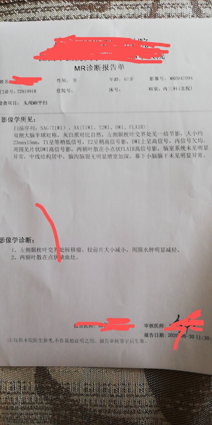 一乙状结肠癌术后6年后脑转移
