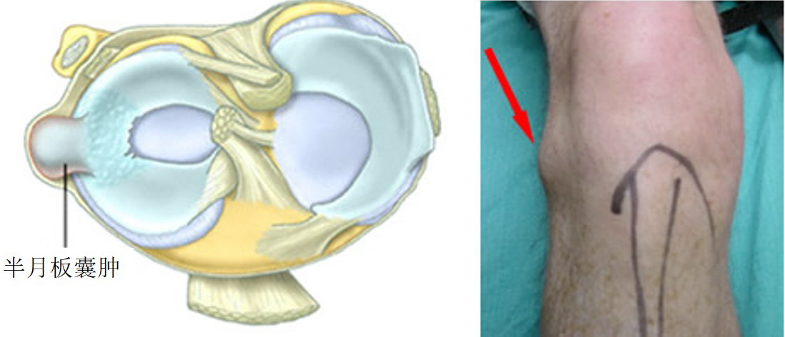 半月板囊肿.左图,外侧半月板囊肿示意图.