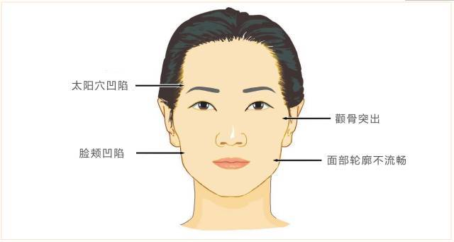 一,面部凹陷最突出表现面部凹陷最突出表现在眼睑,太阳穴,面颊及额头