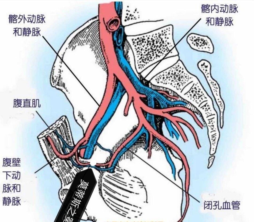 附图 莫蒂斯之冕,是耻骨上支内侧面的骼外血管和骼内血管之间的一些