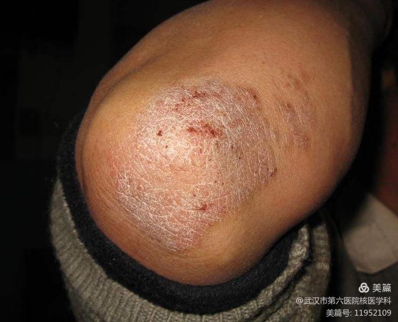 神经性皮炎