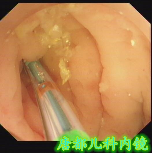 3岁男孩,腹痛1周,门诊查腹部超声提示阑尾炎症,阑尾腔内粪石,今日行