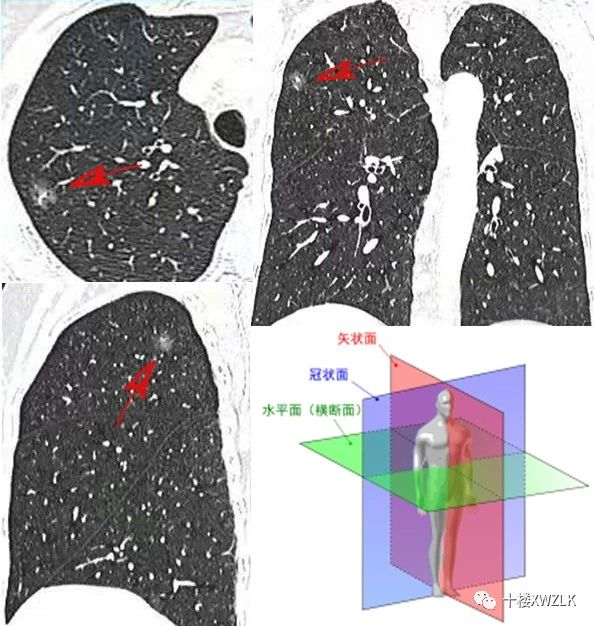 话说肺小结节之普扫胶片与薄层ct_肺部结节 - 好大夫