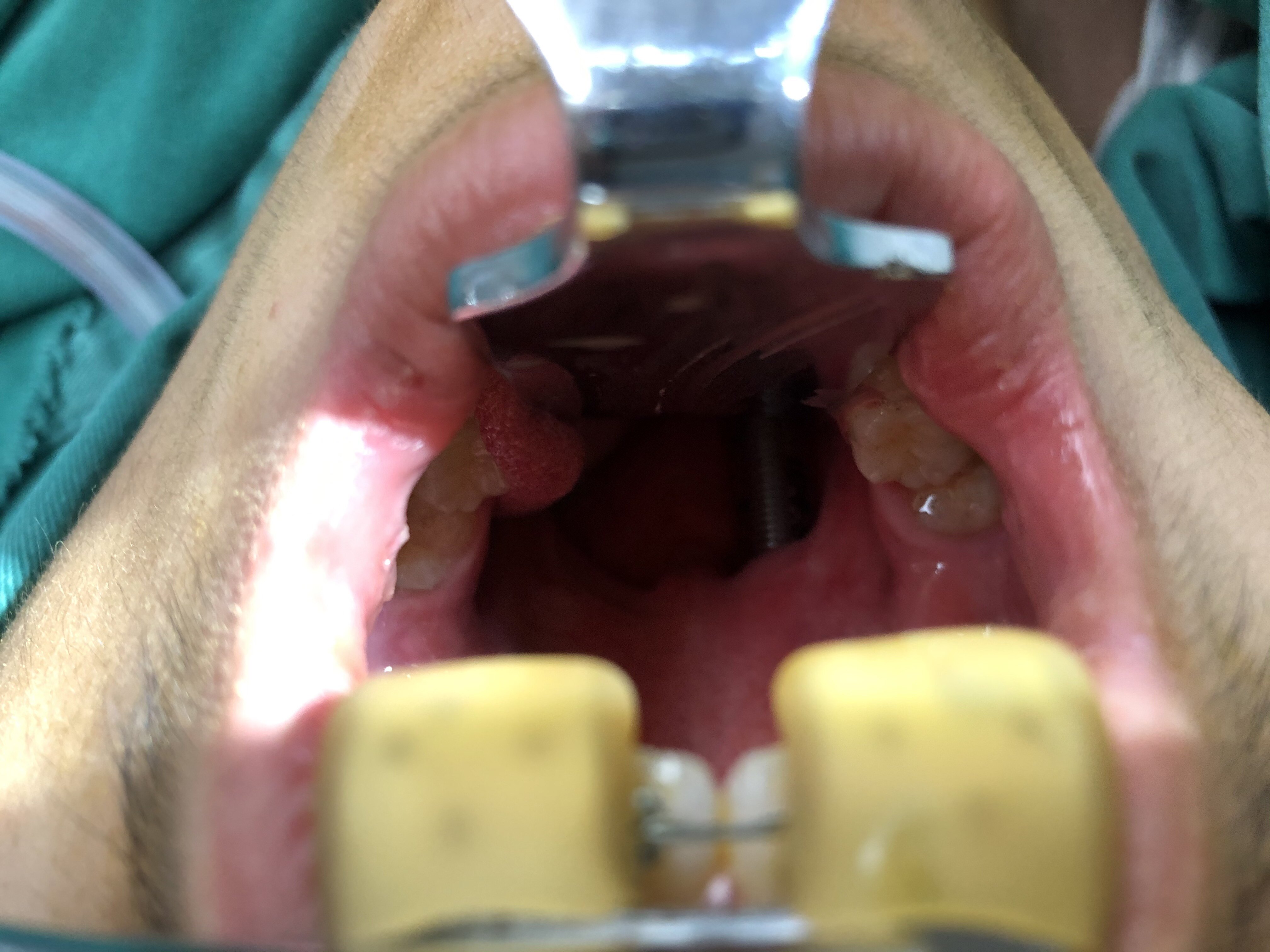 低温等离子消融双侧腭帆间隙脂肪,消融两侧腭咽弓增生的黏膜及组织