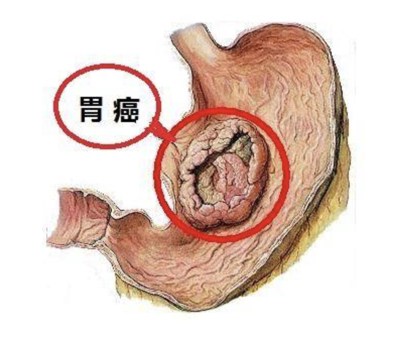 【胃癌预后科普指南】不幸患了胃癌,生存期只有五年吗