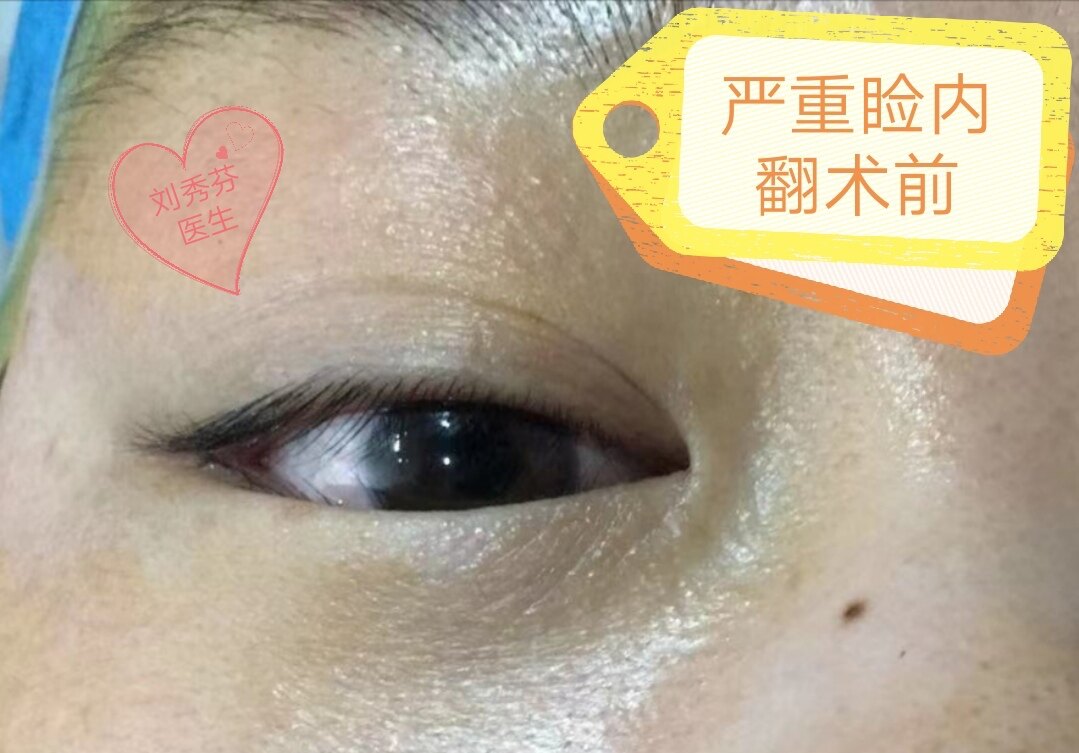 小美女先天睑内翻,被折磨了20多年,终于鼓起勇气做完了手术.