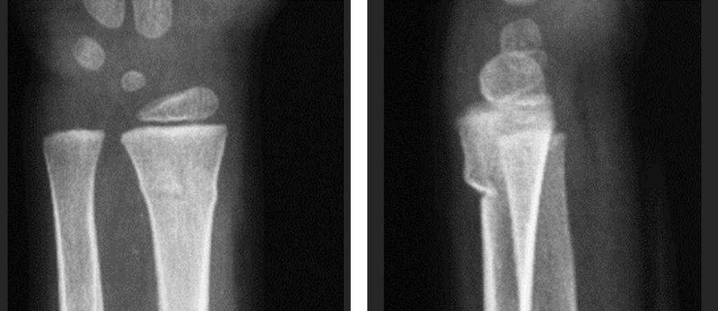 腕关节骨折桡骨远端