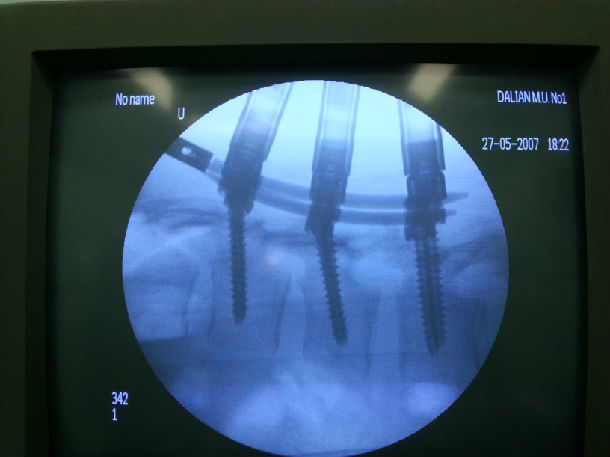 腰1椎体稳定型爆裂骨折闭合复位后路经皮椎弓根螺钉内固定术