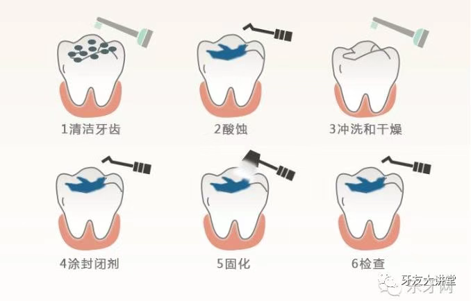 儿童防龋齿窝沟封闭和涂氟是一回事儿吗