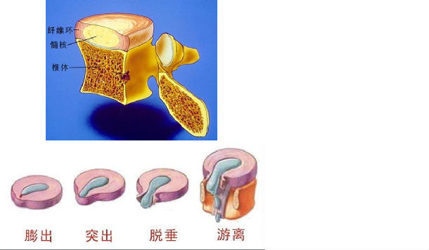 当患者保守治疗无效需要手术时,大部分的患者可选择椎间孔镜手术(大