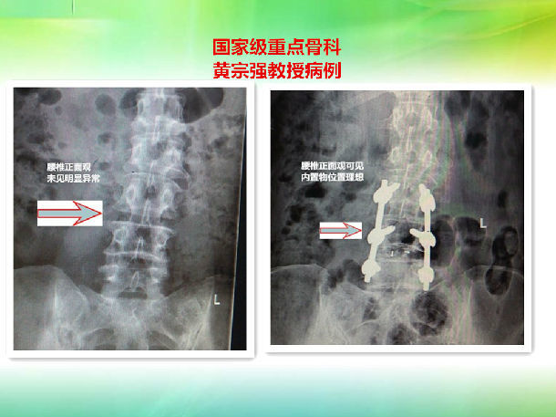 成功进行腰椎椎管狭窄症减压,椎间盘切除植骨融合内固定手术