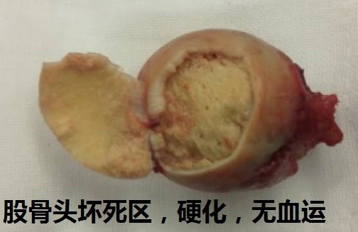 典型股骨头坏死髓芯减压微创手术