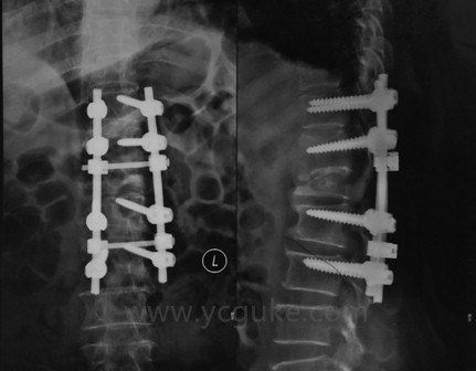 驼背畸形的截骨矫形手术病例(2014.10)