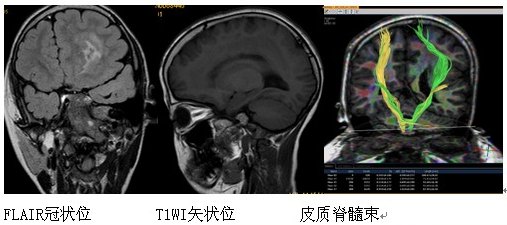 巨脑回畸形