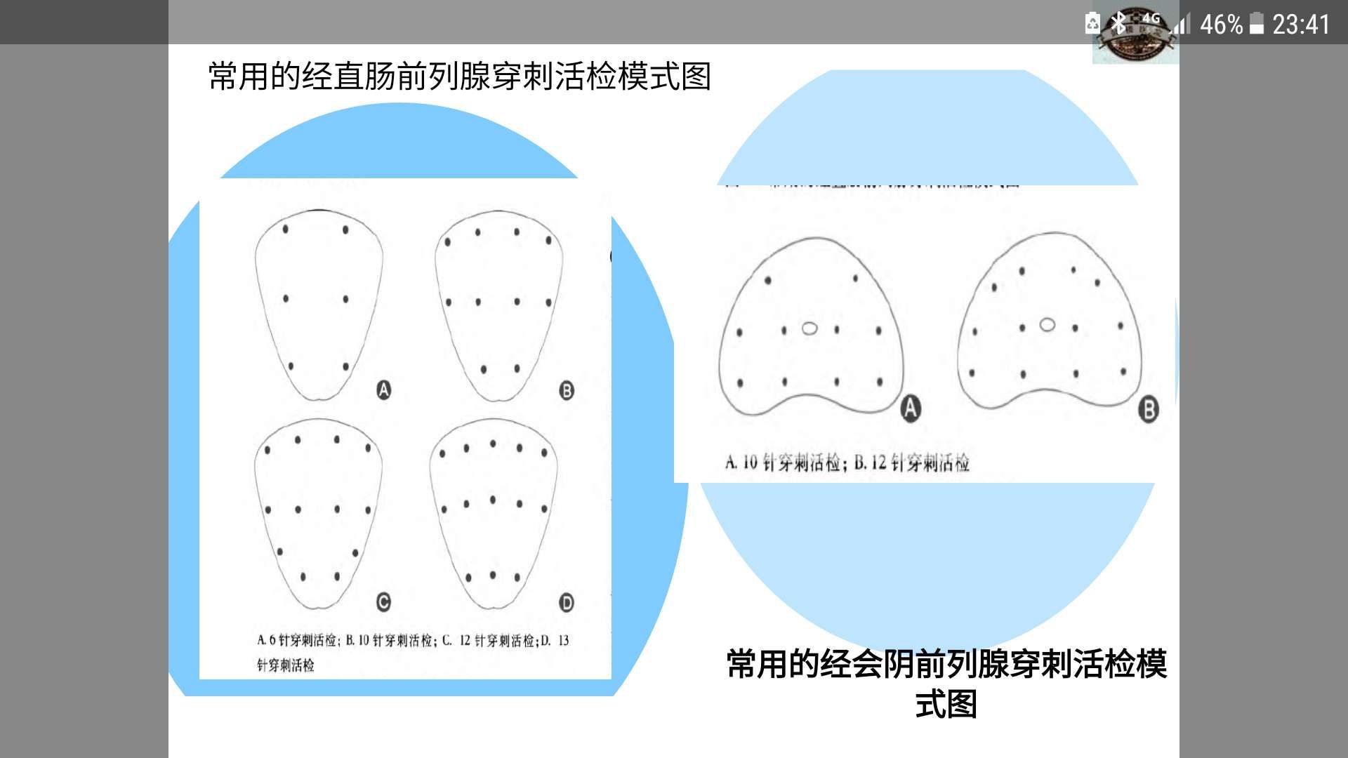 前列腺穿刺活检病理诊断新进展