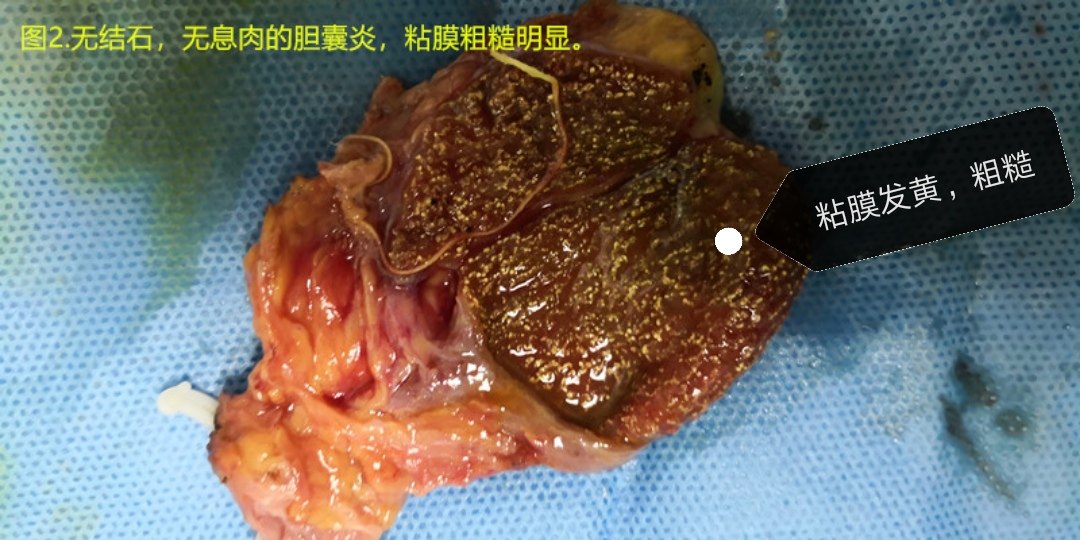 图2.胆囊无结石,无息肉,但是胆囊炎很重,粘膜粗糙.