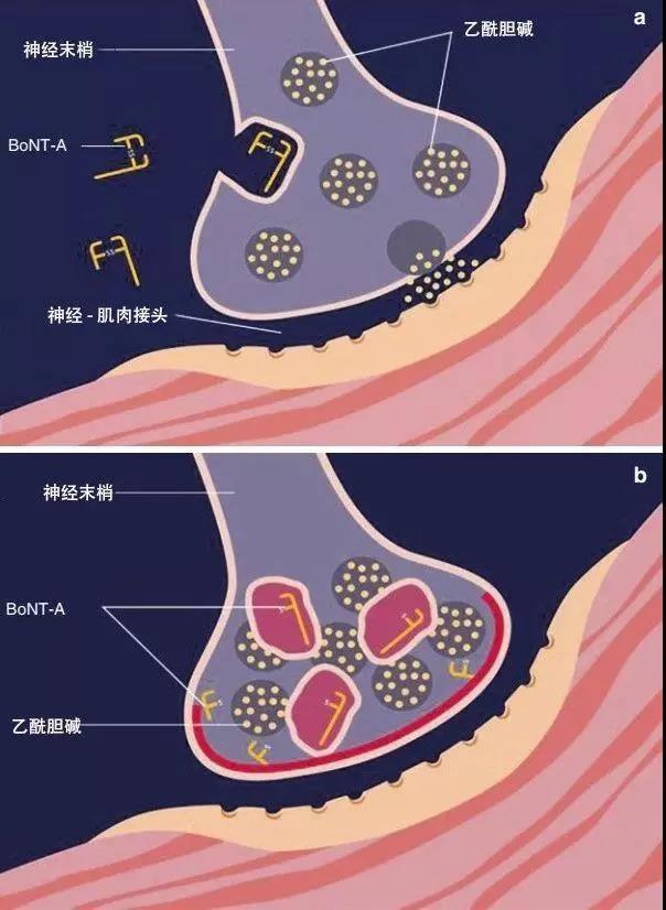 你想知道,那得先了解它的本质还有更多的作用肉毒素不止只有瘦脸这