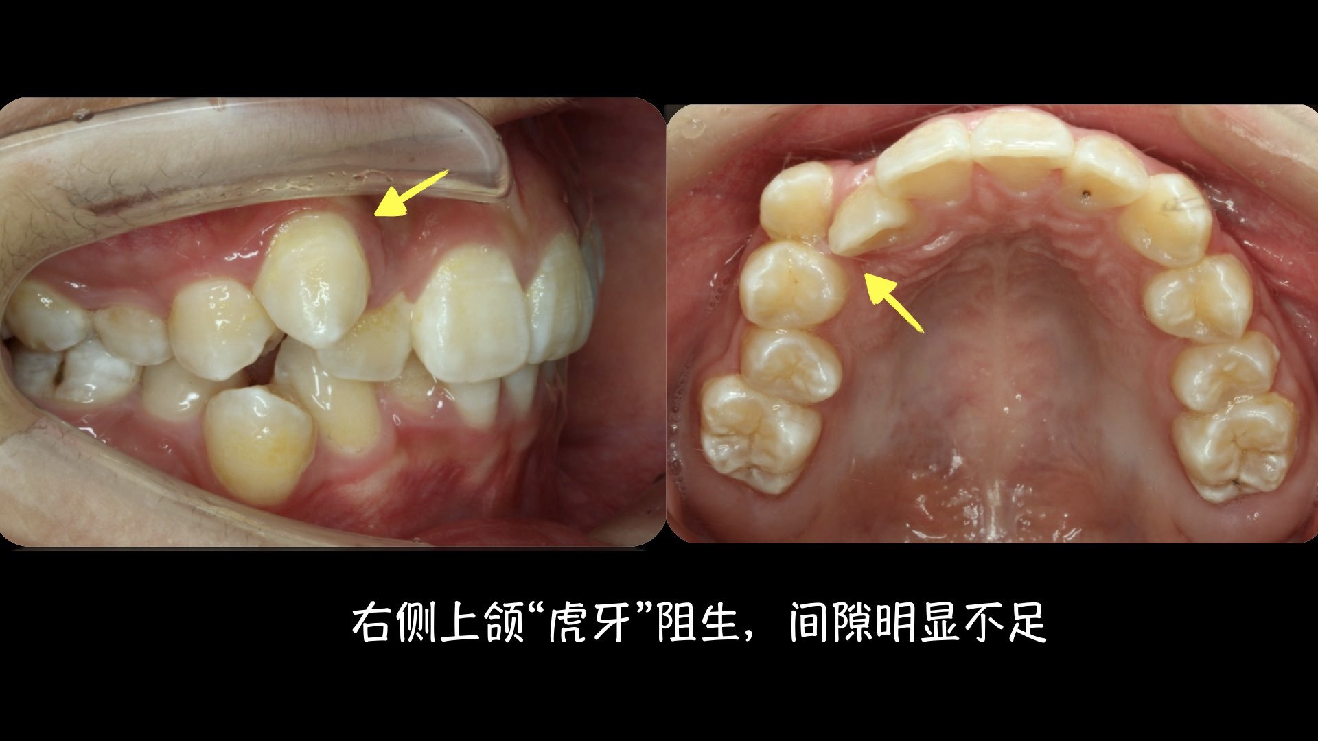 下面是三个" 虎牙 "非 拔牙 矫正的案例,治疗后牙齿排列整齐,笑容灿烂