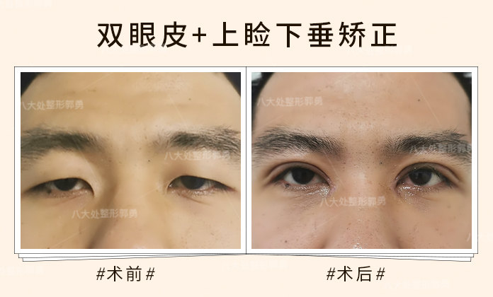 上睑下垂让你总被误会没睡醒