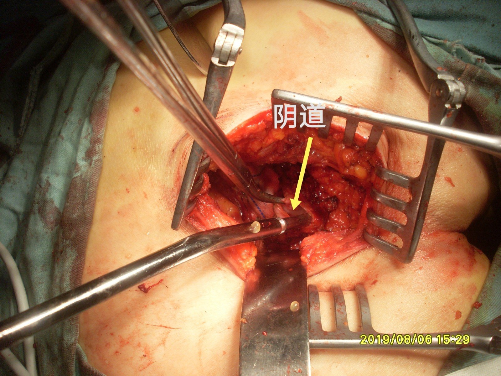卵巢及盆腔肿物,臀部手术必须是切除尾骨前直肠右侧囊肿,为明确诊断