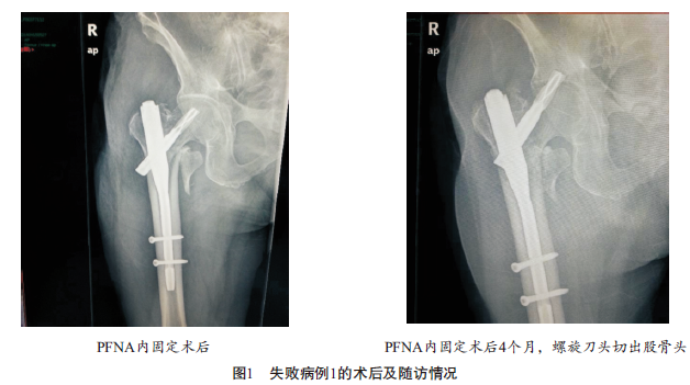 老年骨质疏松性股骨粗隆间骨折pfna术后失败原因分析