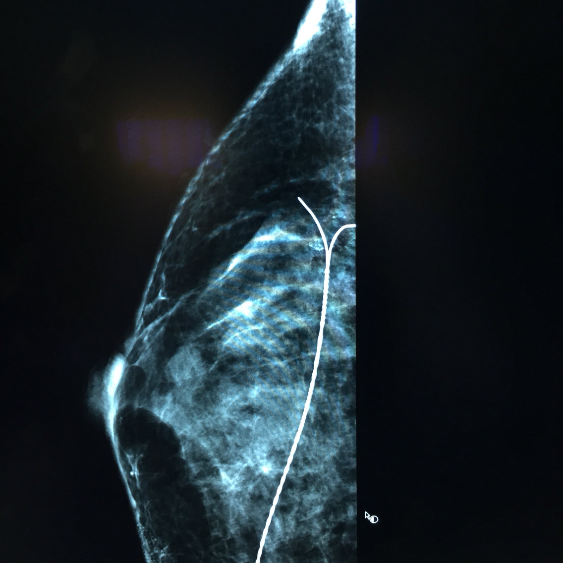 如何对乳房微钙化病灶进行精准定位? - 好大夫
