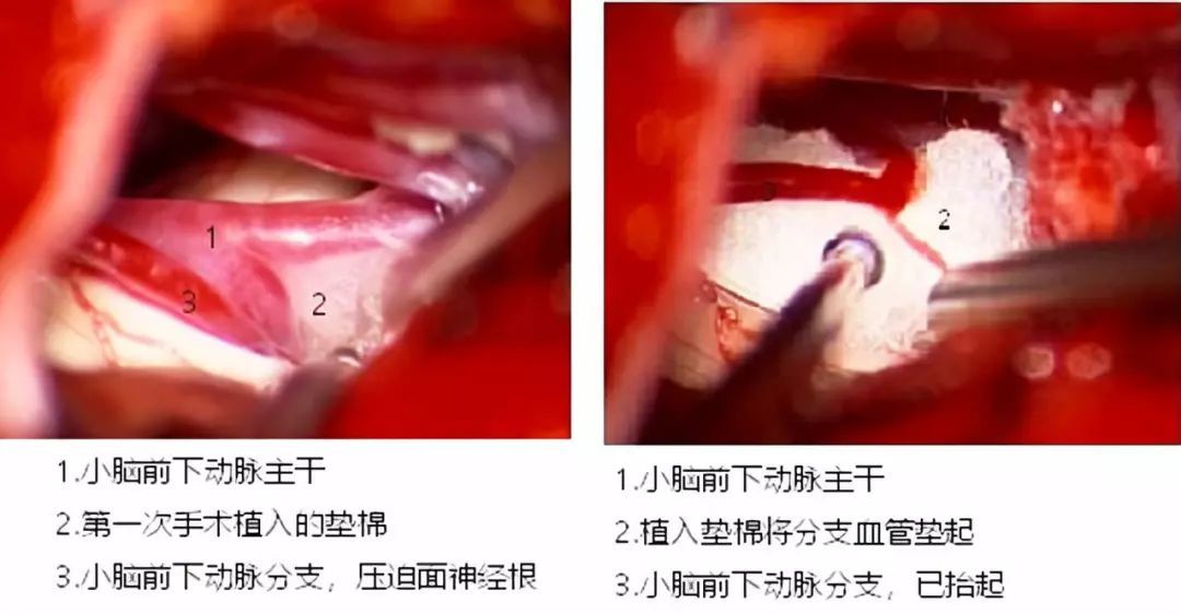 面肌痉挛患者术后又复发二次手术案例