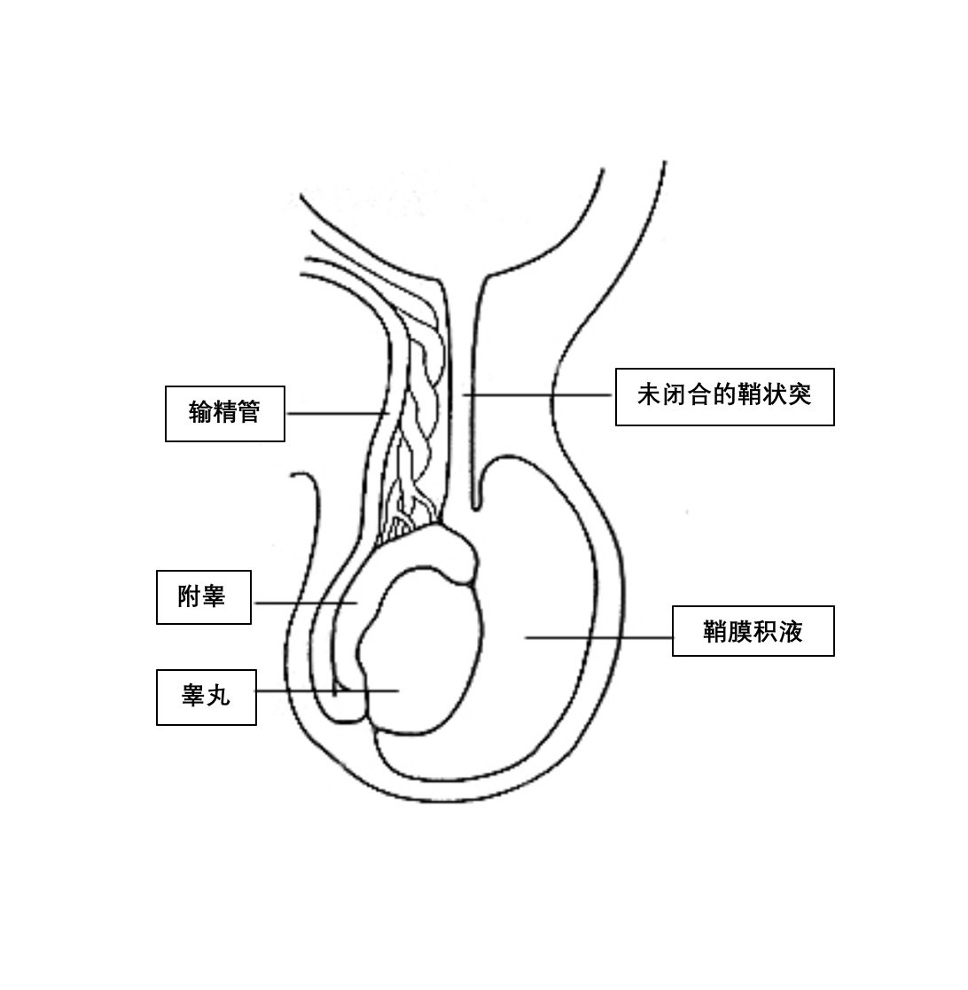 鞘膜积液如何治疗