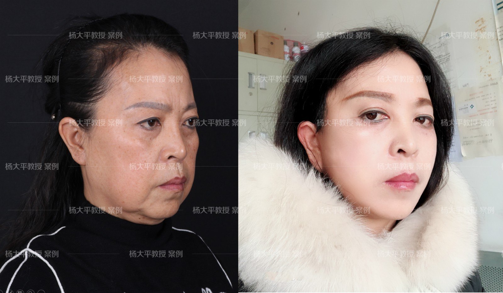 下颌缘线模糊导致女性面部老态