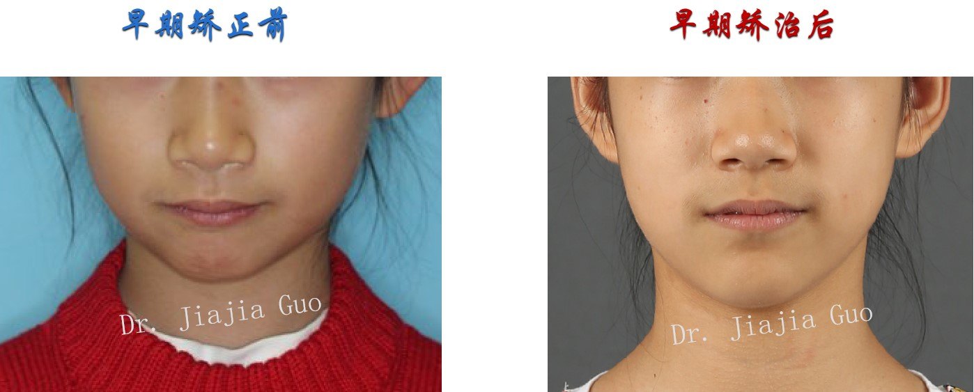 【早期矫正案例】:9岁小姑娘,上颌前突,下颌后缩