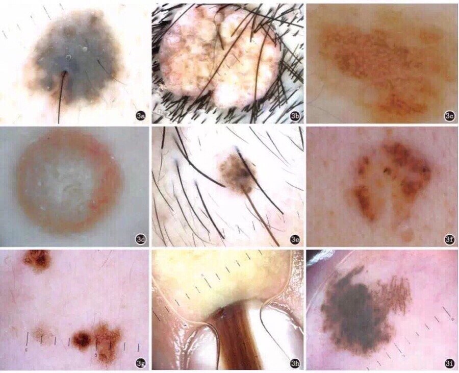 电子皮肤镜轻松诊治皮肤病