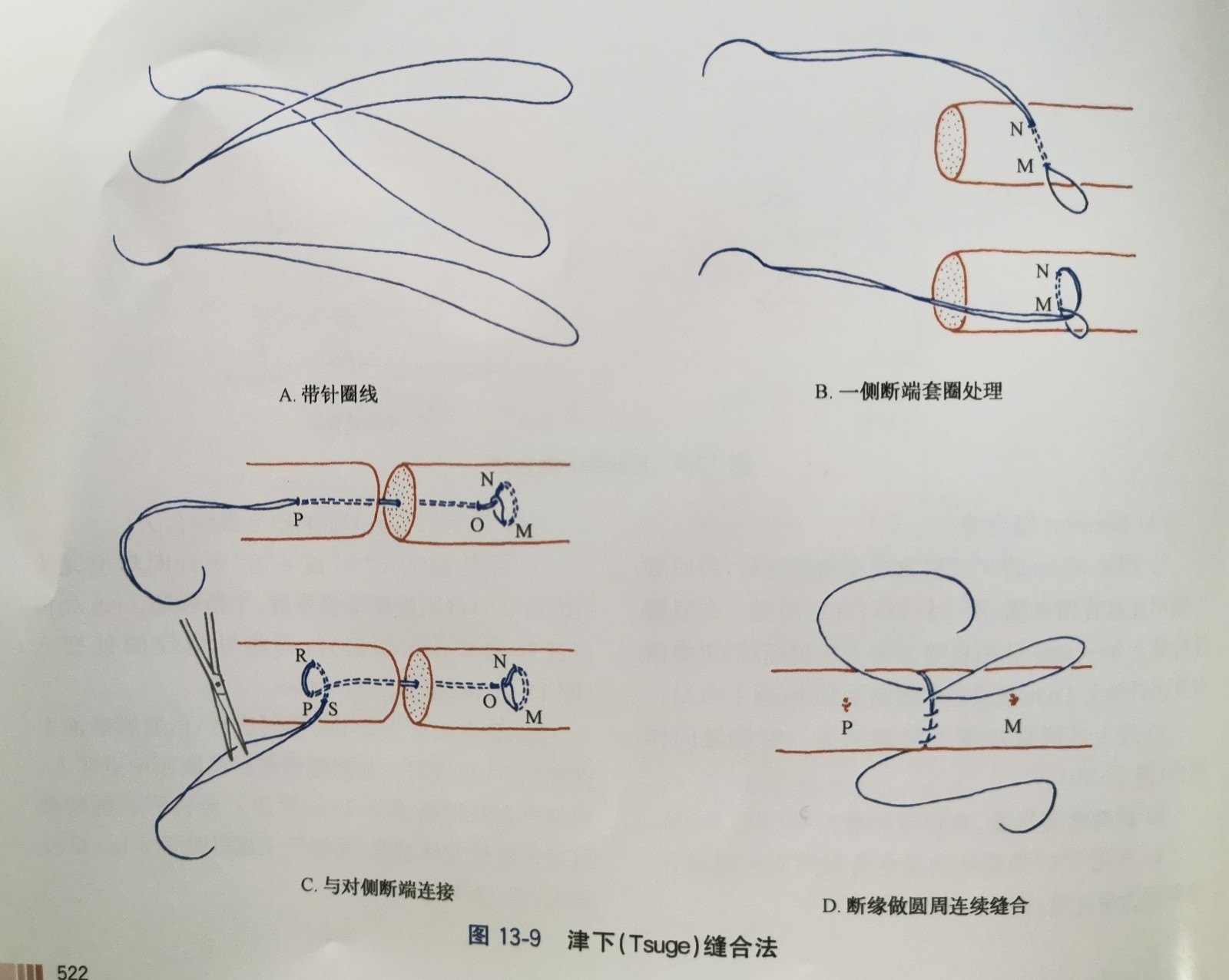 8字缝合法,主要用于缝合扁肌腱及张力不大的肌腱 对比各种缝合方法