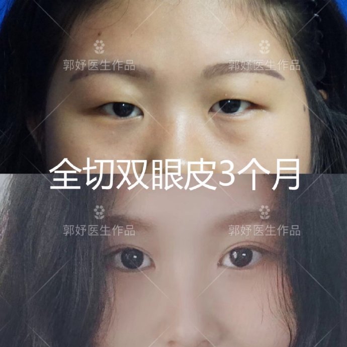 肿眼泡如何做出自然款双眼皮