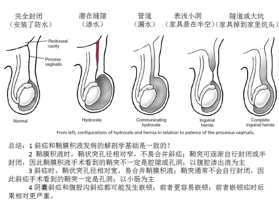 小儿腹股沟疾病(1):睾丸下降的正常发育生物学过程和相关异常的基本