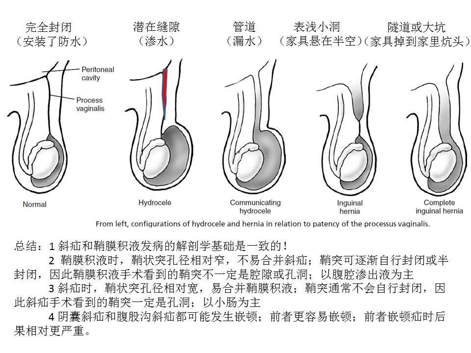 小儿腹股沟疾病(1):睾丸下降的正常发育生物学过程和相关异常的基本