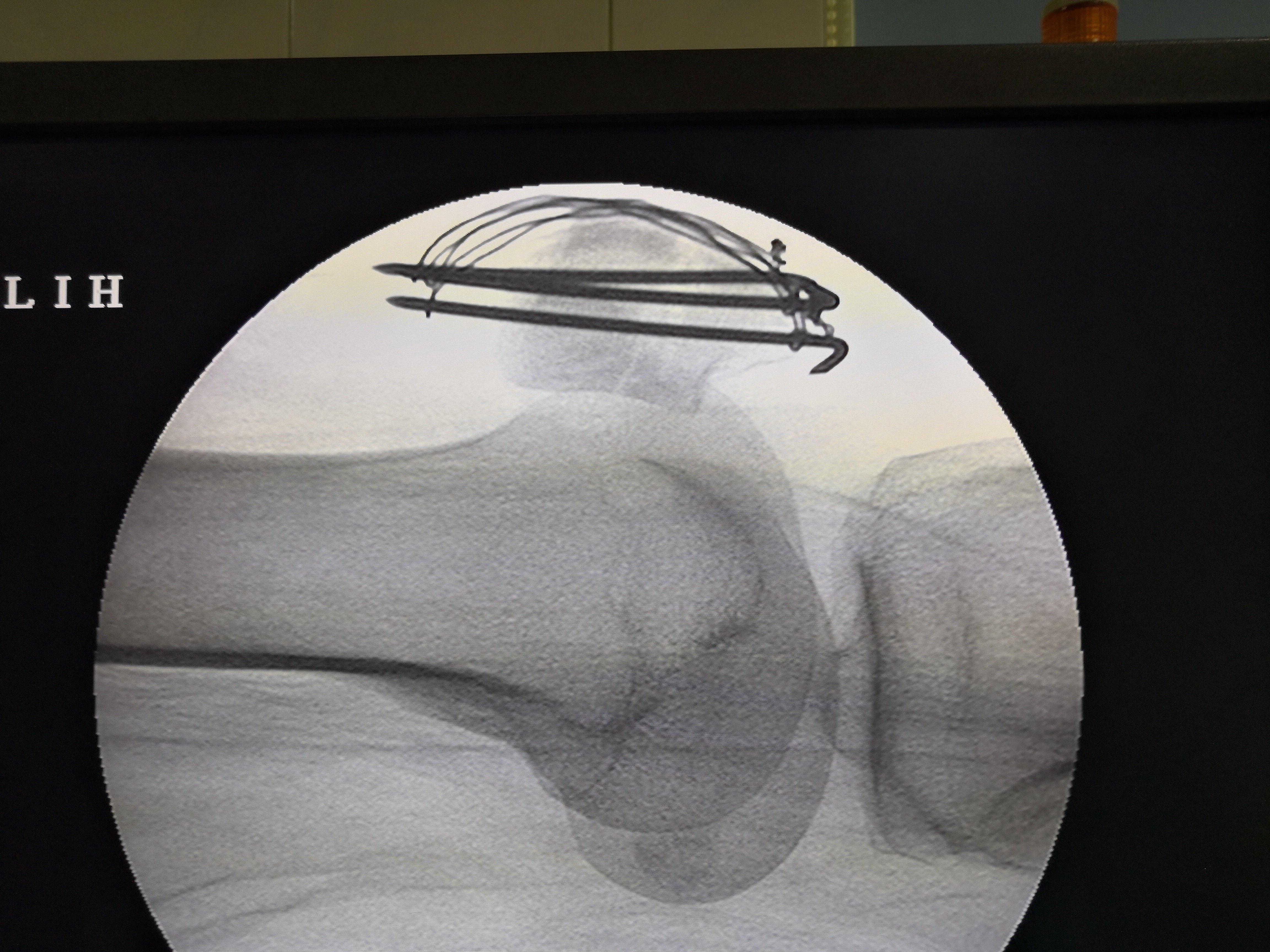 髌骨骨折——微创关节镜辅助下手术治疗