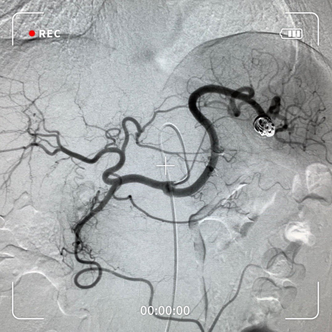 脾动脉瘤介入治疗一例